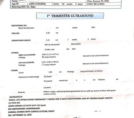 Hirap pag Irregular Meanstration dahil sa PCOS  tapos nawala,  Buntis na pala ako