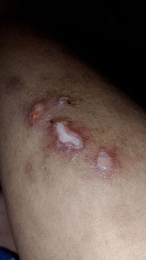 gatel pada kaki
bun ada ngga ya yg pernah gatel kaya gini?,kira kira kenapa ya