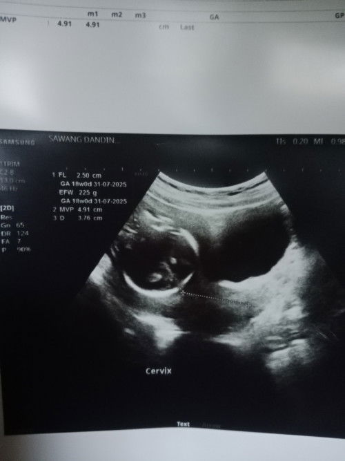 18+6 น้ำหนักน้องได้225กรัม ต่ำกว่าเกณฑ์ไหมค่ะ☺️กัววลเรื่องน้ำหนักลูกมาก