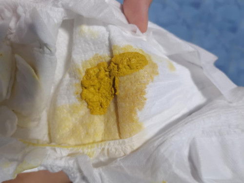 ถ่ายแบบนี้คือท้องเสียใช่มั้ยคะ