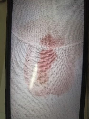 bleeding at 11 weeks