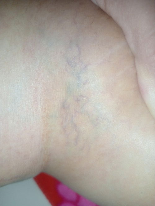 Varises, rasanya seperti kram yg tidak hilang2, dibawa jln susah