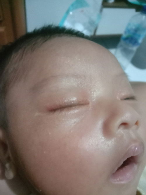 Kelopak mata merah bayi 1 bulan 5 hari