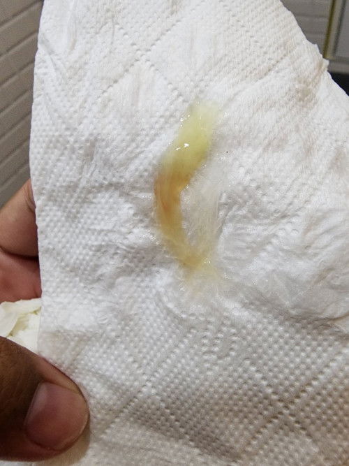 มีมูกปนเลือดนิดหน่อยแบบนี้ใกล้คลอดยังค่ะ 37w5d