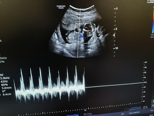 15 weeks scan, Ano po kaya gender?