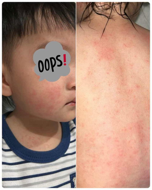 Badan dan wajah anak merah merah gatal