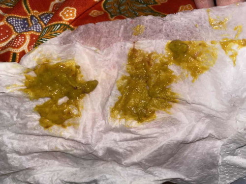 Berak cirit + Lendir darah