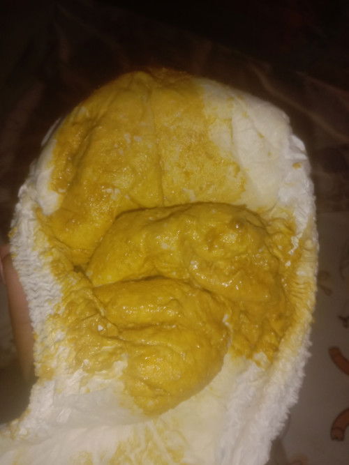 อุจจาระ แบบนี้ของน้องปกติไหมคะน้องได้ 7 เดือน 15 วัน