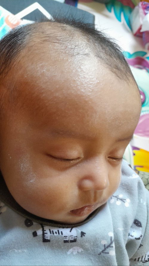 Bintik bintik merah pada bayi