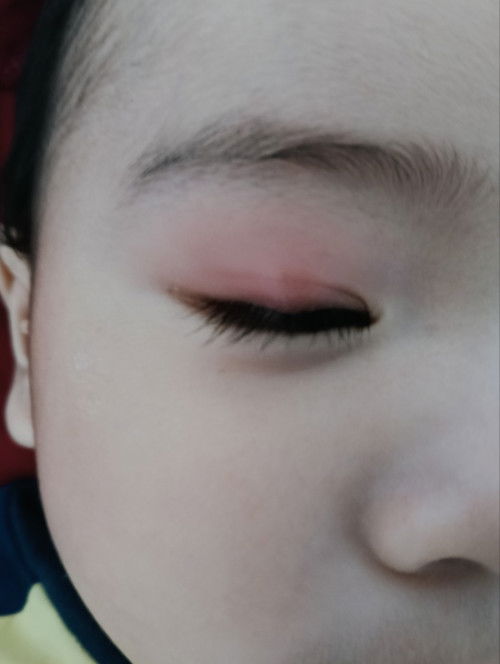 Anak saya 8 bulan, dah jumpa doc suspek kena gigitan serangga atau habuk