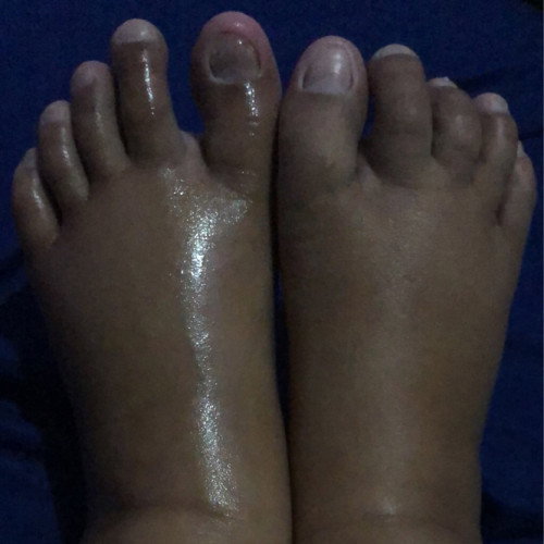 Kaki bengkak