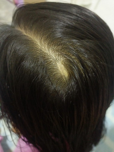 Rambut anak tak tumbuh kesan daripada parut luka(jatuh)