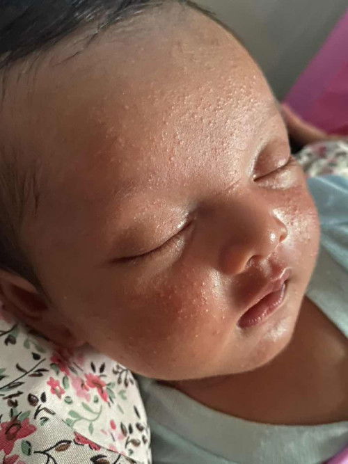 Bruntusan pada wajah bayi