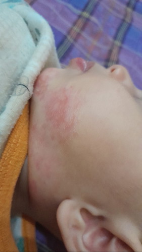 Tlong saran rekomendasi salep atau cream untuk ruam merah di kulit wajah bayi. Kira² in knp y bund?