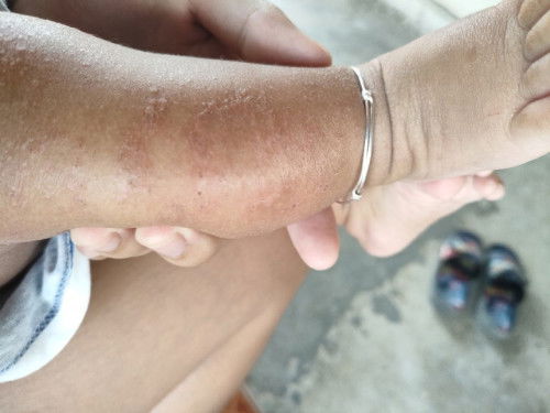 กังวลมากไม่รุ้ว่าลูกแพ้อะไร