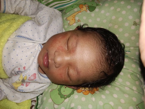 Kemerahan pada muka bayi