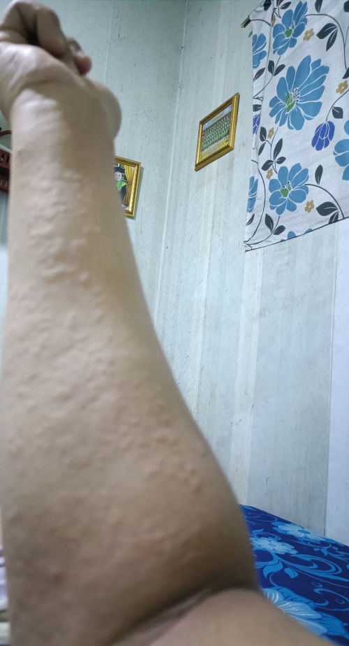 Badan gatal-gatal ketika Hamil