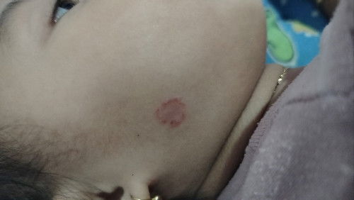 Gatal area wajah pada anak usia 22 bulan