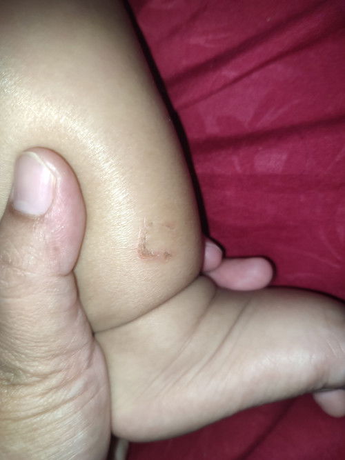 Kulit bayi 7 bulan tiba tiba luka