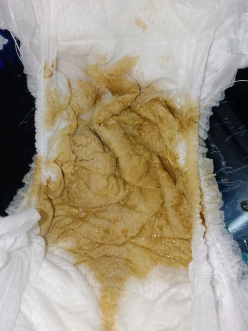 Anak 1 tahun .. Berak cair