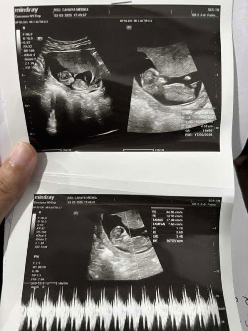 Usia USG yang tepat yg mana