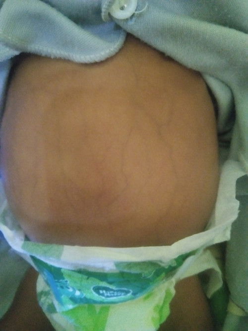 Perut kembung urat kelihatan gimana nyembuhinnya ya bund apakah normal?