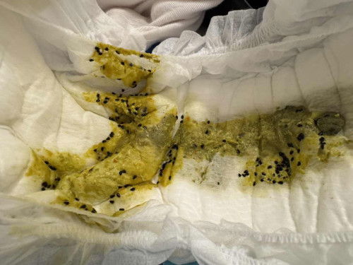 Bayi 5bulan Najis berbiji hitam