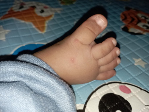 Bekas gigitan nyamuk