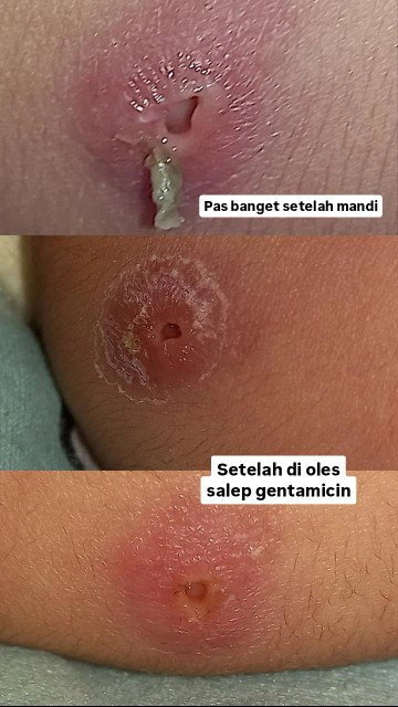 Luka bolong pada bisul bcg