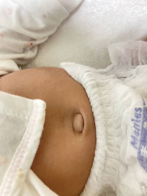 สอบถามเรื่องสะดือน้องอายุ1เดือน25วันค่ะ