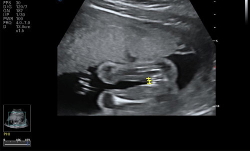Gender scan @20 weeks 4 days