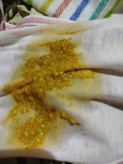 Pup bayi encer dan sering apakah normal bund