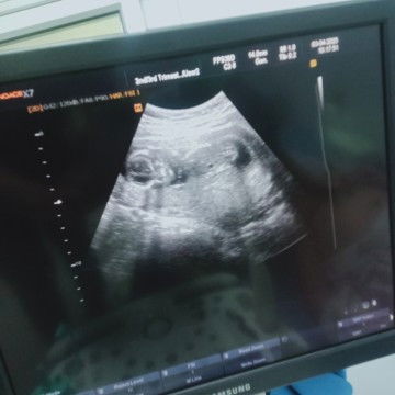 15week+2🤰🏻👶🏻