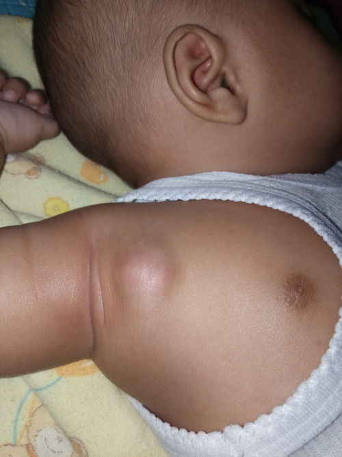 Benjolan di ketiak bayi usia 3 bulan