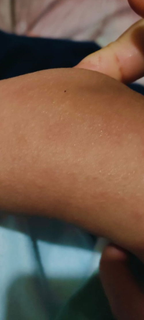 Ruam gatal2 pada anak 2 tahun