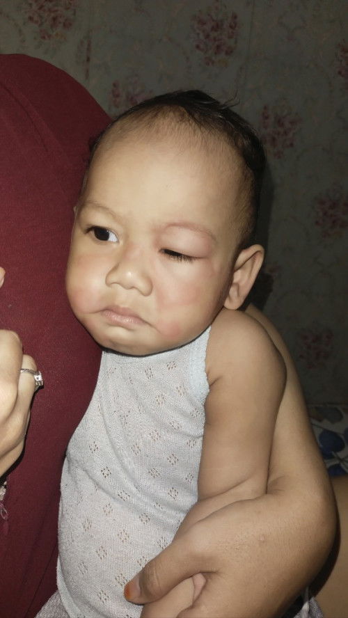 Bentol" beasar di wajah dan leher anak usia 11 bulan