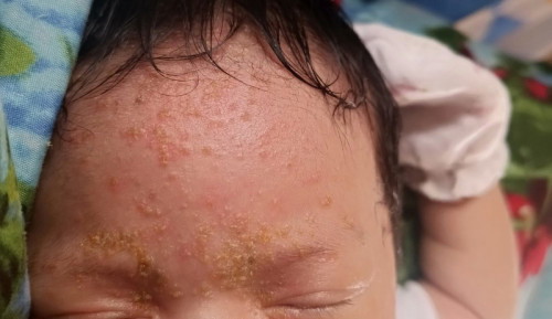 Butlig sa mukha ni baby