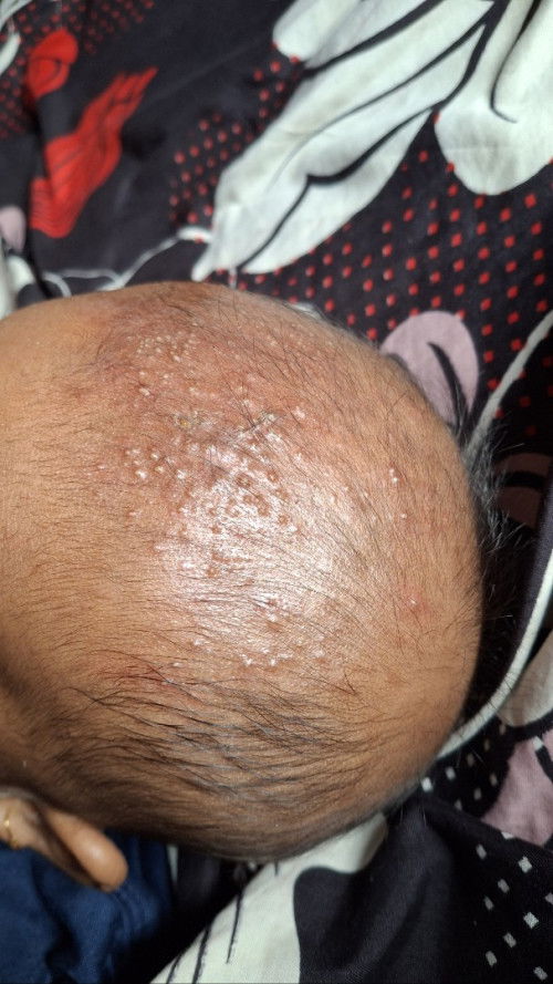 Biang keringat dikepala