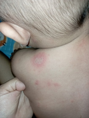 Merah2 di kulit bayi