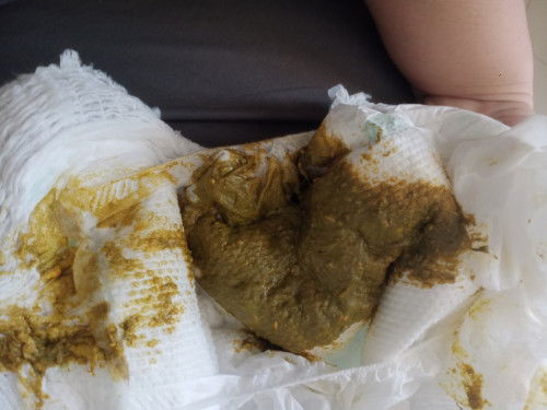 ภาพอาจจะไม่น่าดูหน่อยนะคะเเม่ๆ สอบถามเเม่ๆหน่อยค่ะ สีอึแบบนี้ปกติมั้ยค่ะ น้องกินนมเเม่สลับนมชงค่ะ