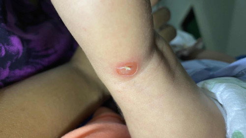 Melepuh pada kaki