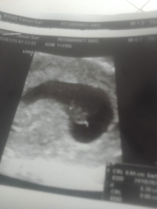 USG 6minggu 5hari