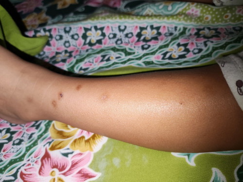 Krim/salep penghilang bekas gigitan nyamuk / luka