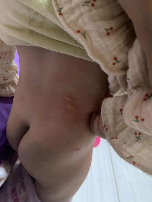 Ini herpes atau apa ya?