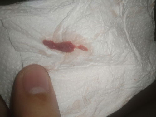 Bleeding at 34 weeks