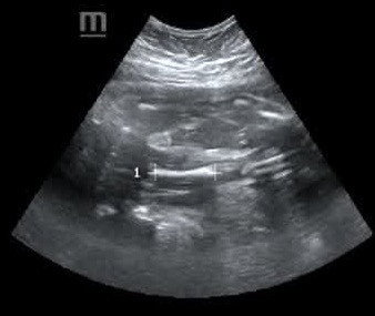 BoY or GiRl ya?