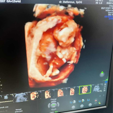 Screening downsyndrom