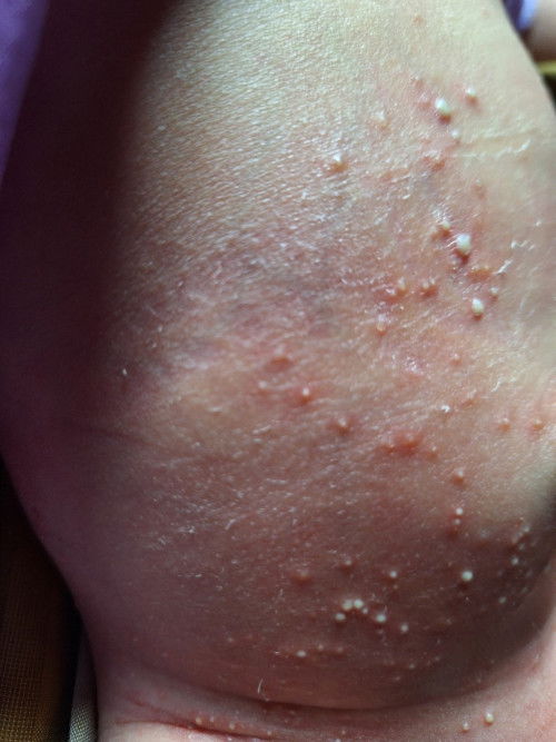 Bentol2 Merah Bernanah