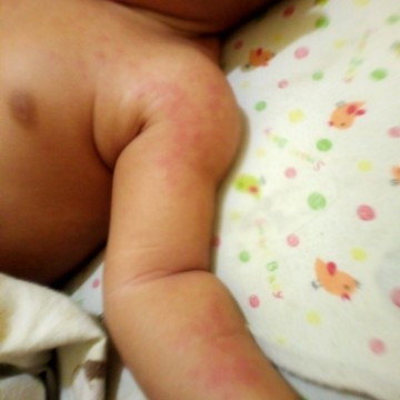 Bunda"anak ku usia 3bulan tangan nya pada bintik"merah kanan kiri sama leher trs kaki sran dng