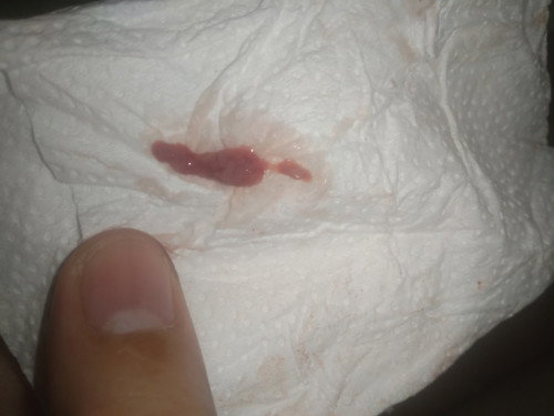 Bleeding after sex 34 weeks pregnant